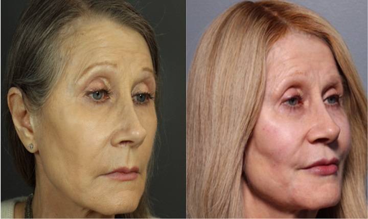 Do you need botox to look young in your sixties?